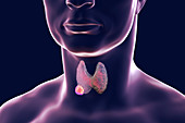 Thyroid gland tumour, artwork