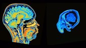 MRI brain scans alternating
