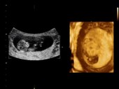 12-week-old foetus, ultrasound scans