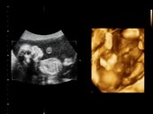 26-week-old foetus, ultrasound scans