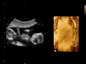 16-week-old twin foetuses, ultrasound scans