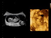 12-week-old triplet foetuses, ultrasound scans