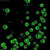 Leukaemia cancer cells, fluorescence light micrograph