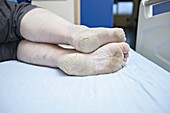 Dry and cracked feet in diabetes