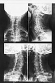 Osteoarthritis of the neck, X-ray