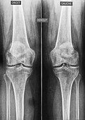 Osteoarthritis of the knees, X-ray