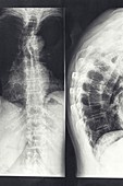 Spinal compression fracture, X-ray