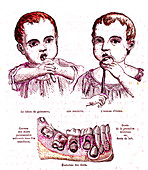 Teething child, 19th Century illustration
