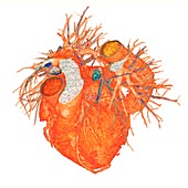 Heart with coronary artery disease, 3D CT scan