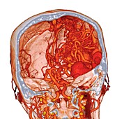 Cerebral arteriovenous malformation, 3D CT scan