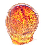 Brain in white matter disease, 3D MRI scan