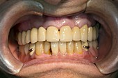 Dental bridge and prosthesis