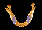 Lower jaw bone, micro-CT scan