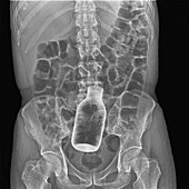 Bottle in rectum, X-ray