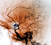 Cerebral aneurysm, angiogram