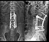 Implants following spinal surgery, X-rays