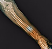 Fractured ulna arm bone, X-ray