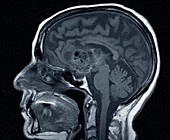 Astrocytoma brain cancer, MRI scan