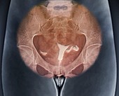 Female infertility, hystero-salpingogram