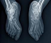 Rheumatoid arthritis of the feet, X-ray