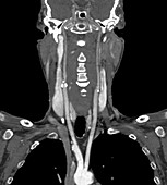 Narrowed carotid arteries, CT angiogram