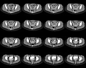 Two-horned uterus, axial pelvic CT scans