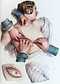 Breast removal surgery, illustration