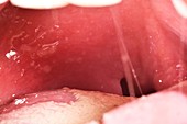 Infected tonsil, quinsy