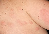 Urticaria