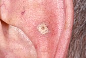 Bowenoid keratosis