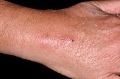 Inflammation at intravenous cannula site