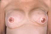 Breast reconstruction after cancer