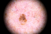 Seborrheic keratosis, dermatoscope image