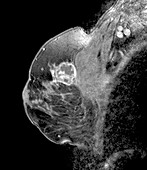 Breast tumour, sagittal MRI scan