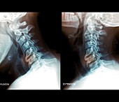 Osteoarthritis of the cervical spine, X-rays