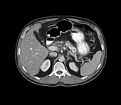Pancreatitis, axial CT scan