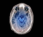 Stroke, MRI brain scan