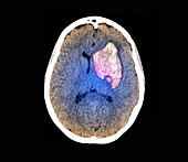 Intracerebral haemorrhage, CT brain scan