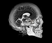 Human skull and brain, CT and MRI scans