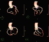 Coronary artery stent evaluation, 3D CT angiography