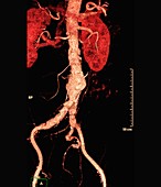Cholesterol embolism, 3D CT angiogram