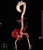Aorta and re-implanted kidney, 3D CT angiogram