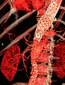 Stent in aortic dissection, 3D CT angiogram