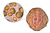 Cryptococcal meningitis, illustration