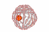 Brain cancer, illustration