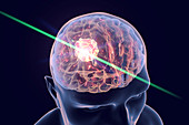 Brain cancer treatment with laser, illustration