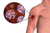 Skin ulcer in leishmaniosis, illustration