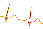 ECG, illustration