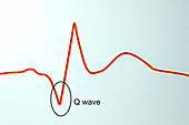 ECG in myocardial infarction, illustration