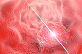 Oesophageal cancer treatment, illustration